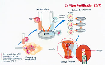 Cost of IVF Treatment in Tamil Nadu